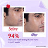 2% Salicylic Acid Face Wash for Acne & Oil Control - 100 ml
